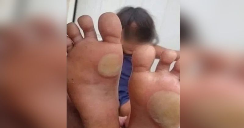 Mujer le quema los pies a su hija con una plancha