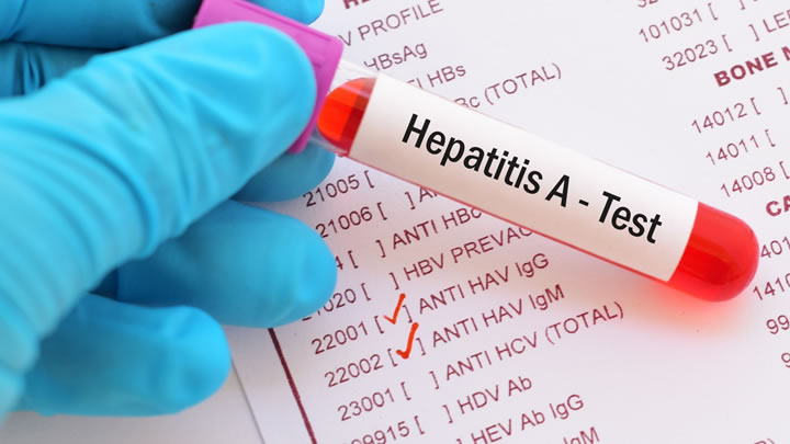 Van 21 casos de hepatitis A en la entidad en lo que va del año