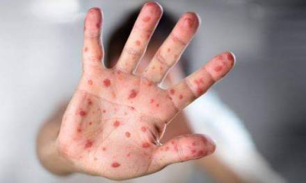 Se intensifican casos de sarampión por falta de vacunas