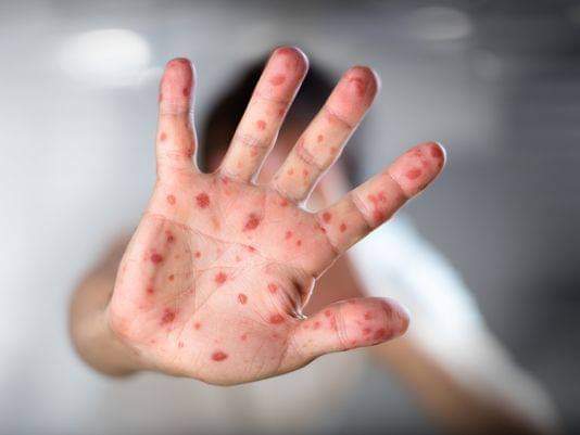 Se intensifican casos de sarampión por falta de vacunas