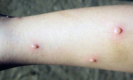 Al menos 109 casos de varicela: SSH