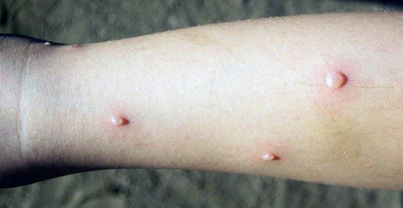 Al menos 109 casos de varicela: SSH