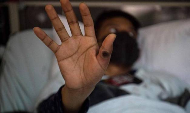 Confirman 3 casos de viruela del mono en Hidalgo