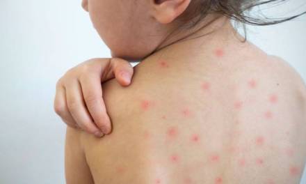 Confirman primer caso de sarampión en Hidalgo