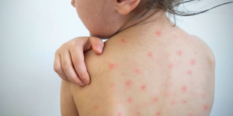 Confirman primer caso de sarampión en Hidalgo
