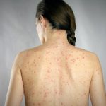 Detectan nuevo caso de sarampión en Hidalgo