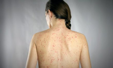 Detectan nuevo caso de sarampión en Hidalgo