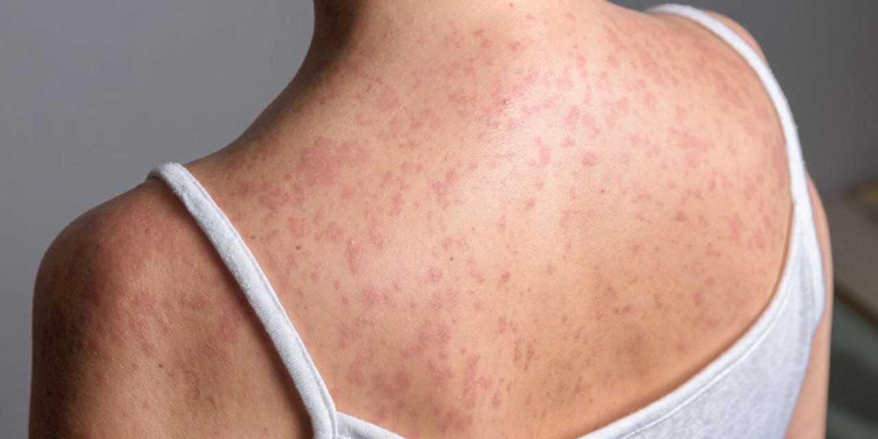 Hay 6 casos activos de sarampión